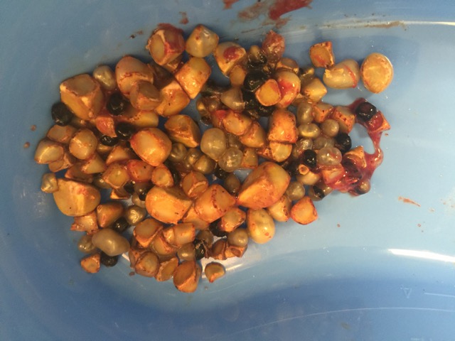 gallstones