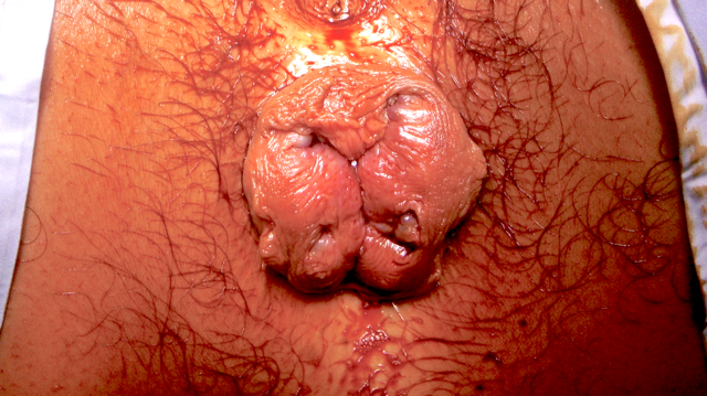haemorrhoids